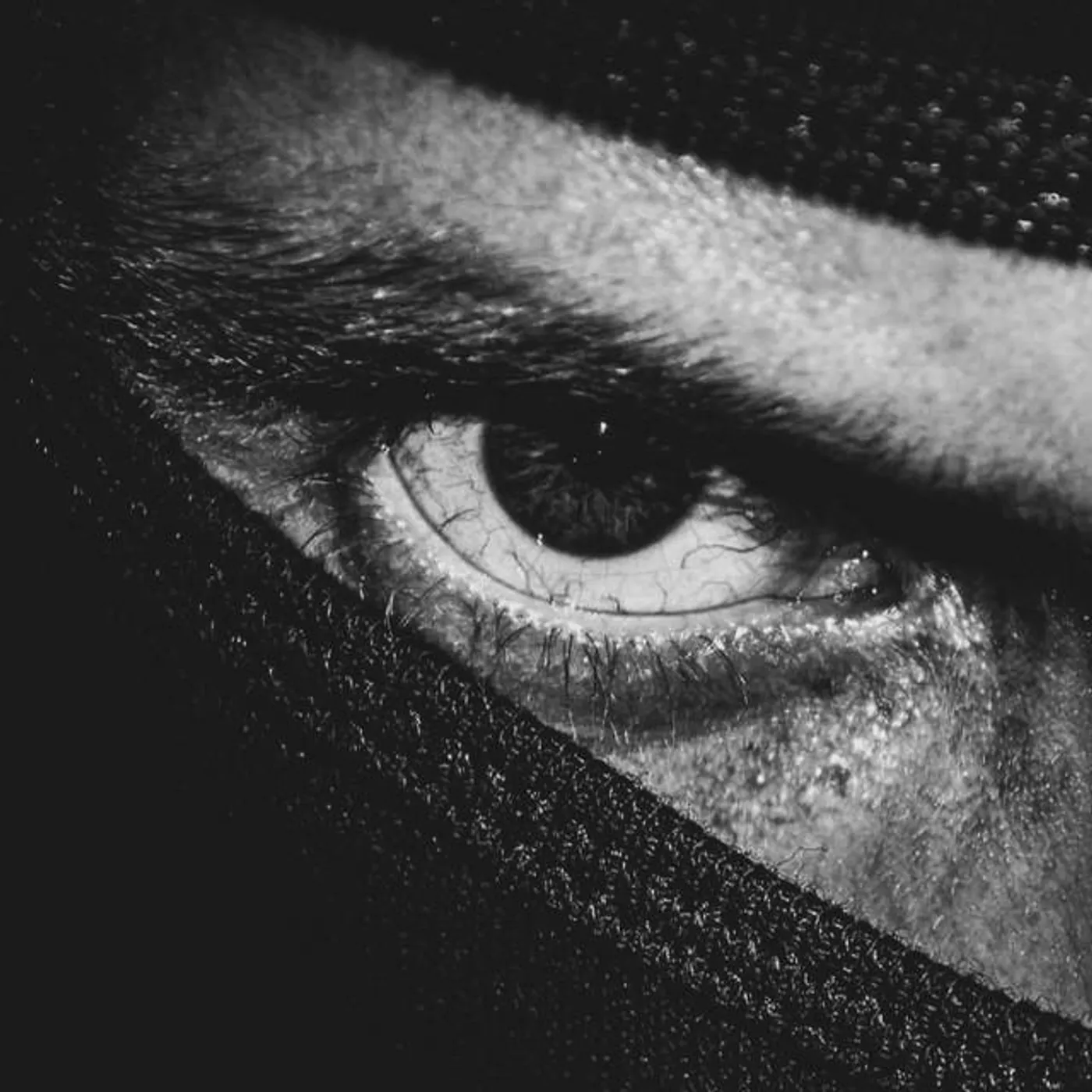 Cataract