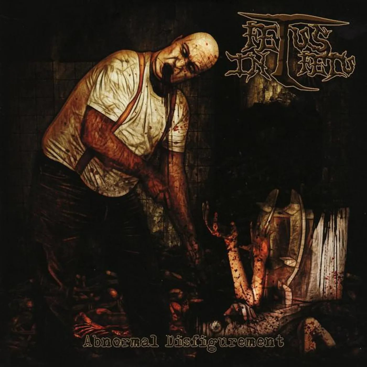 Fetus In Fetu