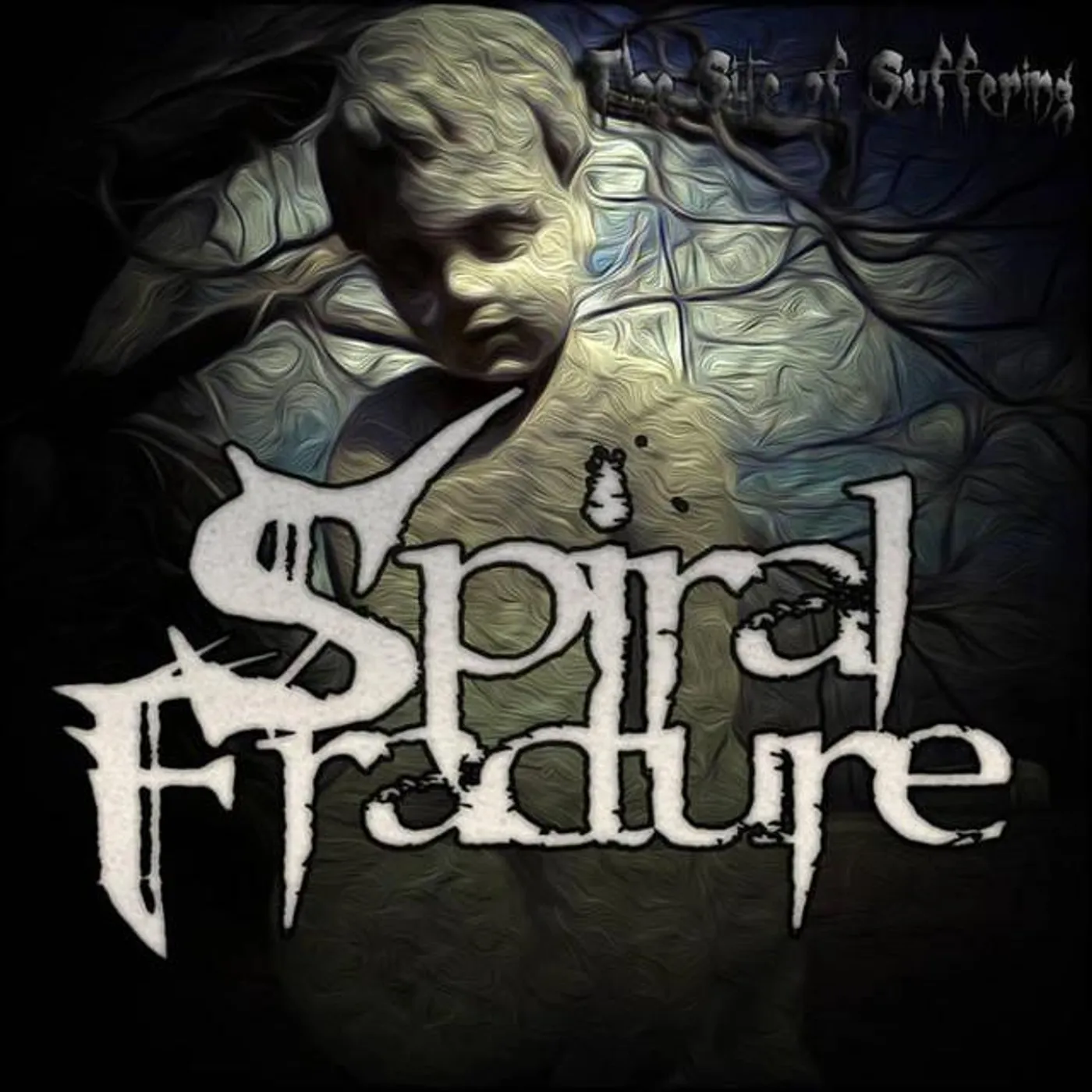 Spiral Fracture