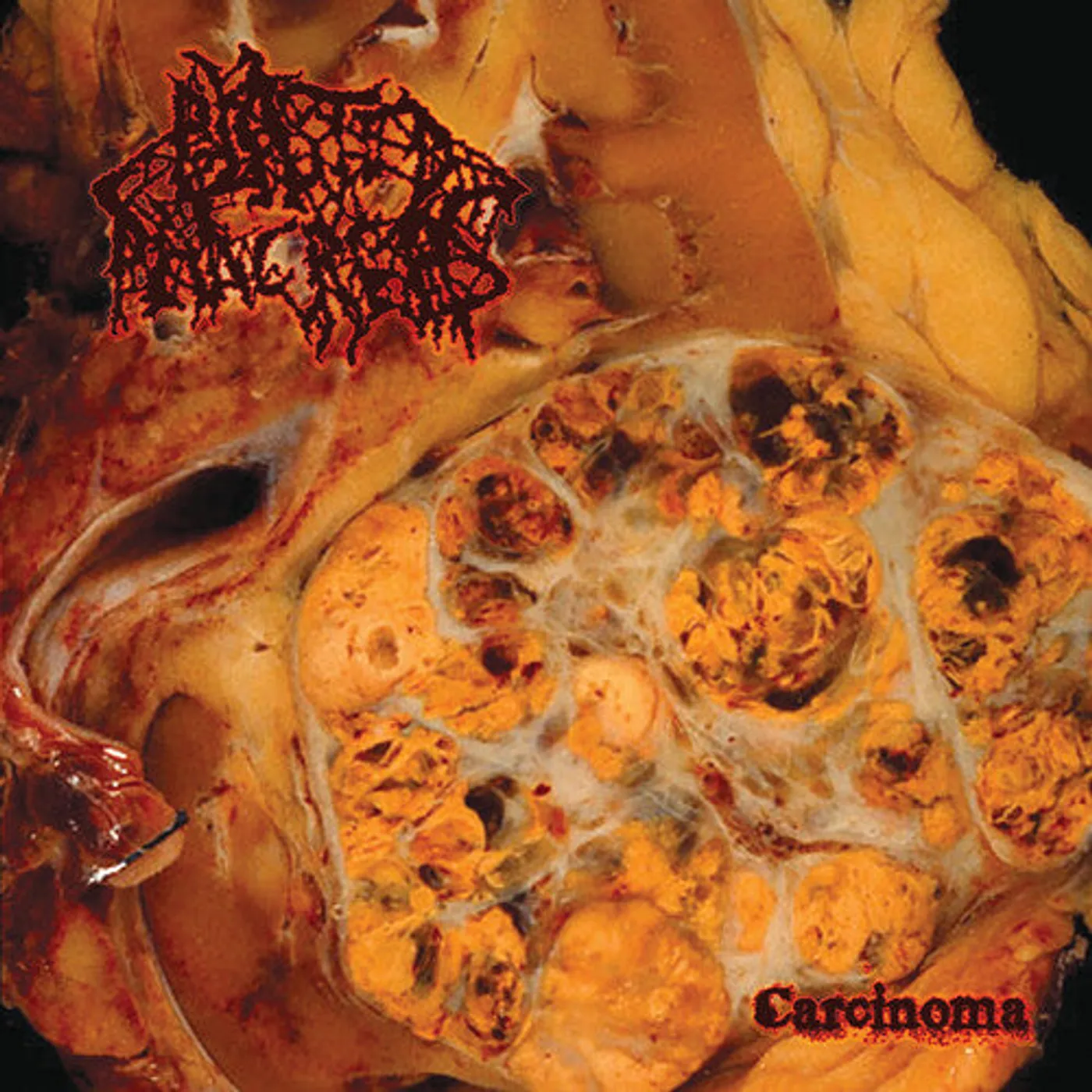 Blasted Pancreas LP Vinyl - Carcinoma (Coloured Vinyl) (Ltd) (Red)